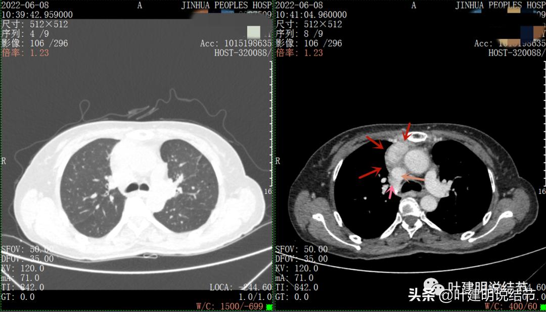 这位老乡，乏力来查，查出这么大个的纵隔肿瘤！会是什么呢？