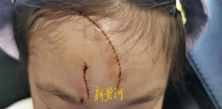 江苏一5岁女童被大狗咬伤致毁容，狗主人系公职人员