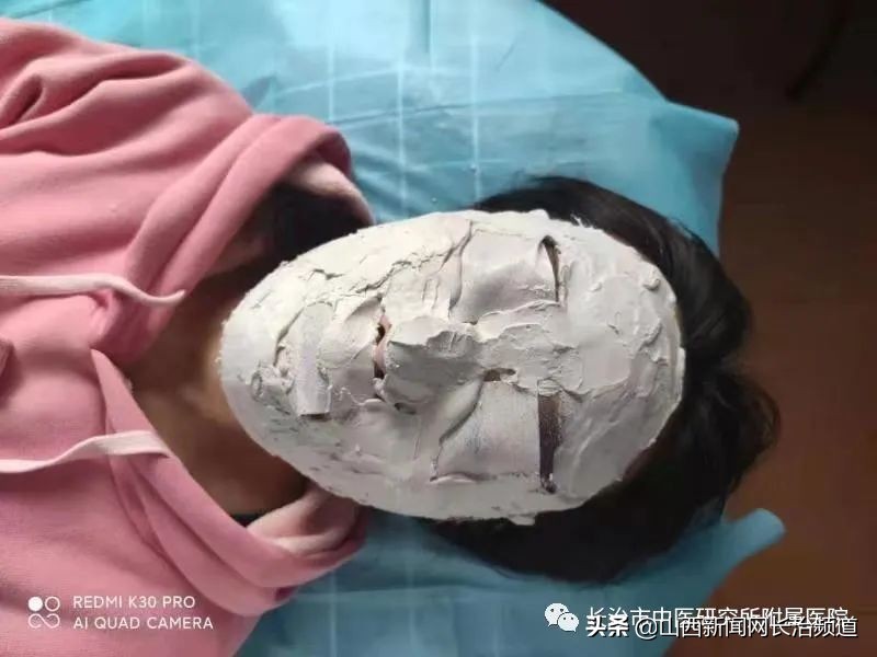长治市中医研究所附属医院皮肤科用“火针+中药+倒模”疗法成功治疗一例中重度*疮痤**患者