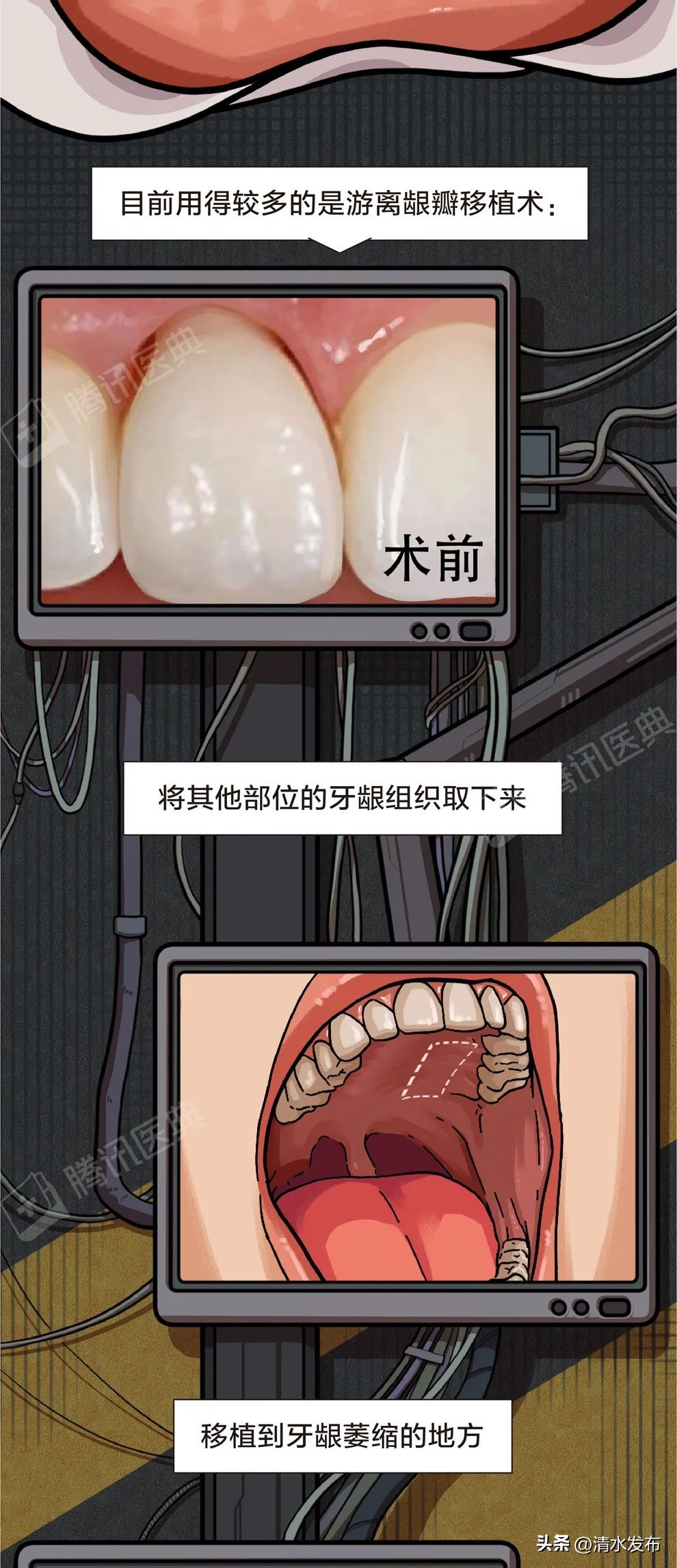 两边大牙一吃肉就塞牙如何修复,14岁学生吃肉老是塞牙需要矫正吗