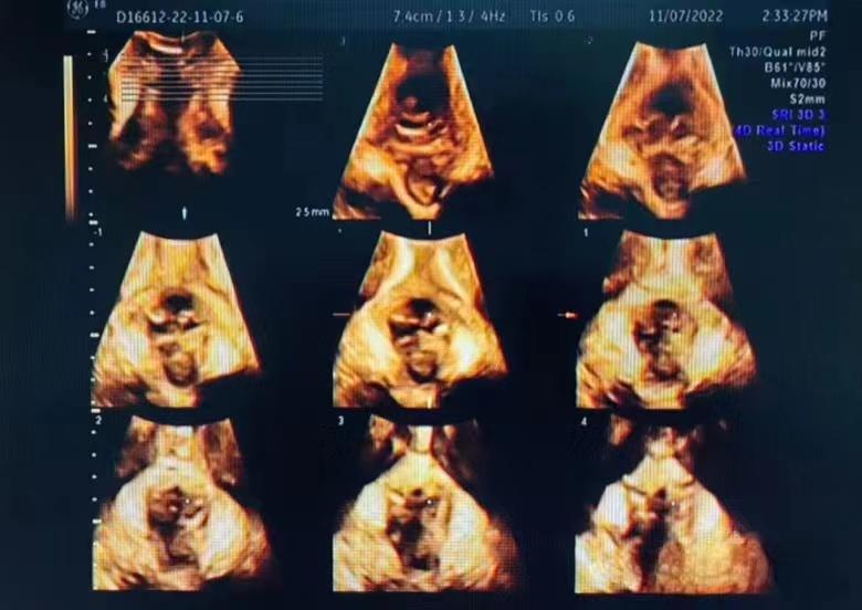 关爱女性盆底健康图片,呵护女性从盆底康复开始