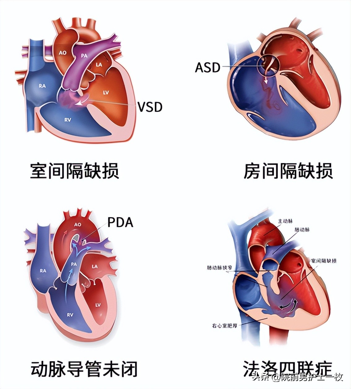 阿斯综合征的用药和治疗方法,阿斯综合征的护理诊断有哪些