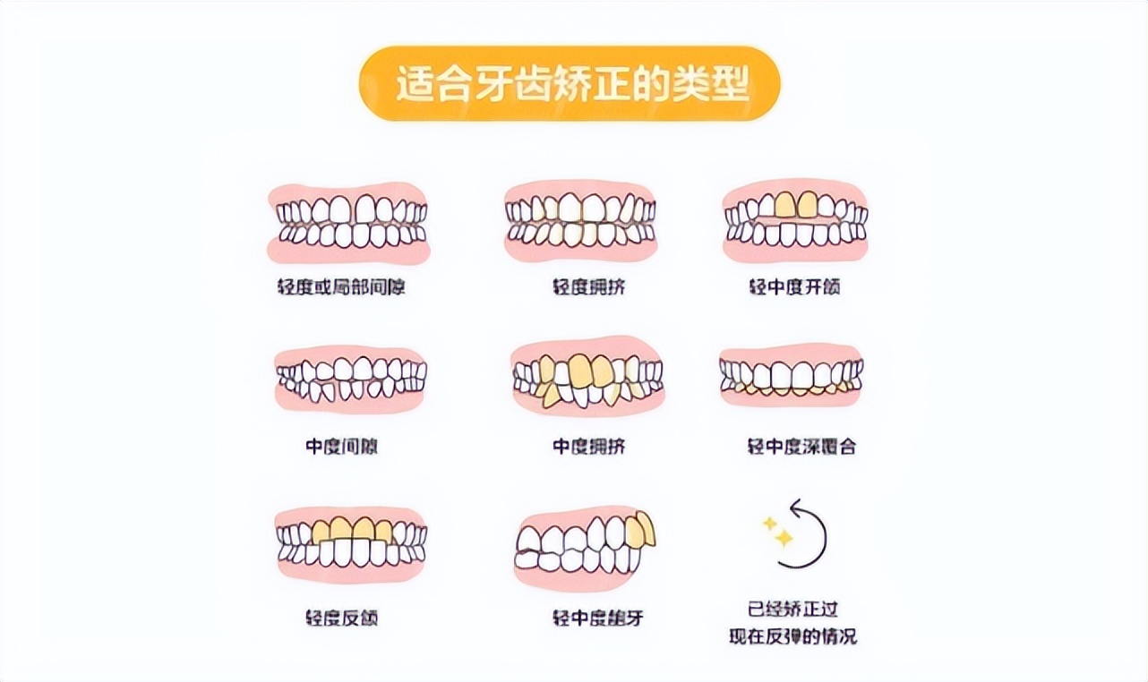 牙齿畸形的矫正是怎么个方法,8种牙齿畸形必须矫正一图读懂