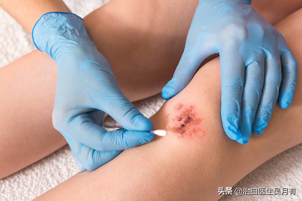 外伤导致白癜风概率大吗,外伤引起的白癜风照308有效果吗