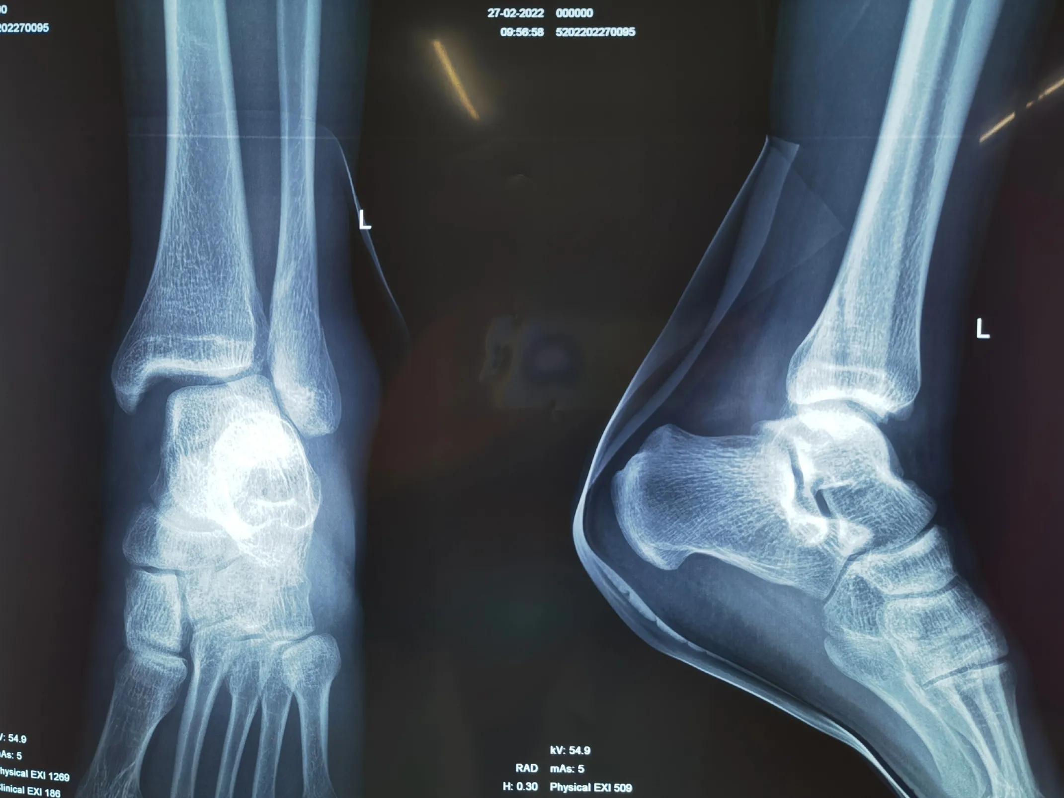 踝关节骨折需要做手术吗,踝关节骨折需要手术吗