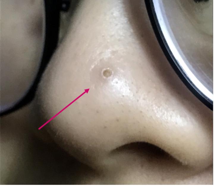 黑头没挤干净怎么办,黑头没及时处理变成黑痣了怎么办