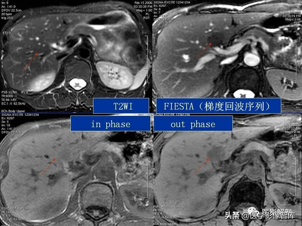 肝炎性假瘤鉴别诊断,肝炎性假瘤影像学表现
