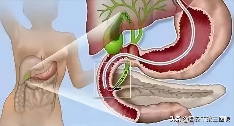 介入治疗|ERCP联合PTCD显神威顺利解除患者“顽石”困扰