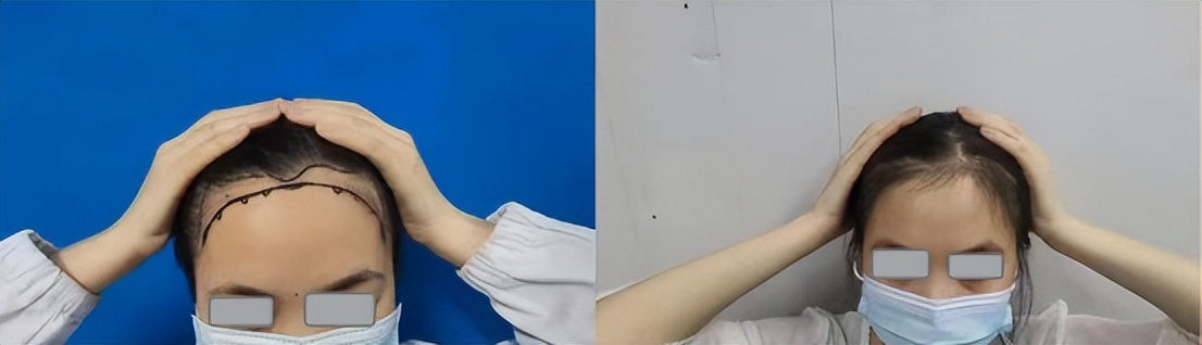 脱发后毛发还能移植吗,毛发移植会脱发吗