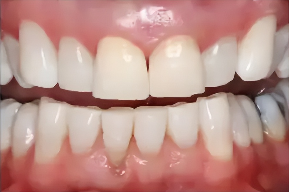 牙齿黄怎么变白去口臭,有牙黄口臭教你轻松解决