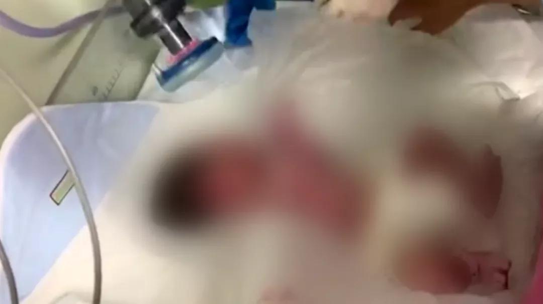 新生儿急性肾衰竭能治愈么,新生儿急性肾衰竭治好的几率