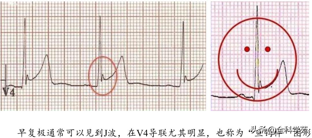 t波高尖心电图判断标准,t波高尖判断标准