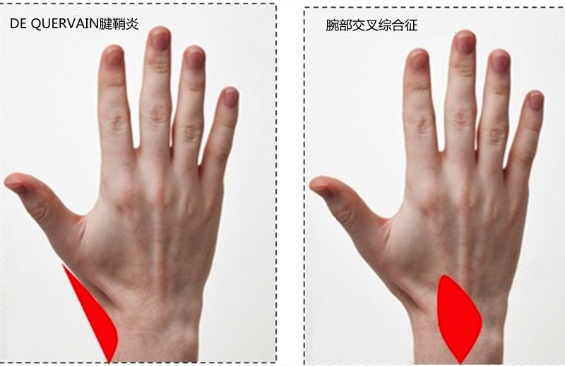 常玩手机手指痛小心得了腱鞘炎,玩手机腱鞘炎大拇指关节疼怎么办