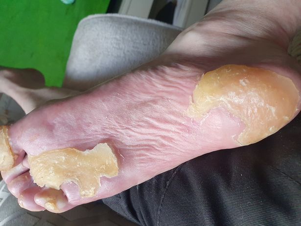 英国男子患罕见怪病,英国61岁癌症老头