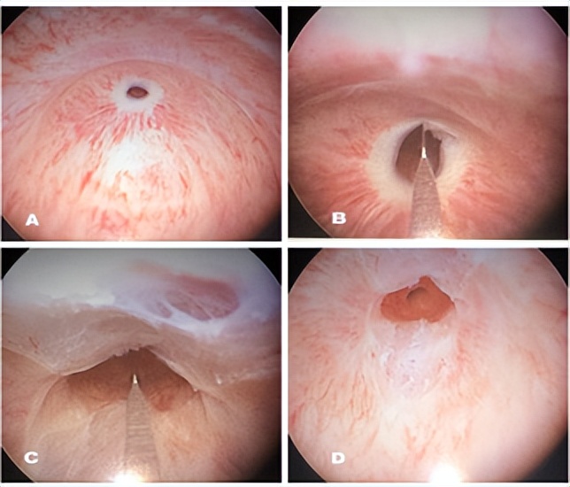 排尿困难是哪里出了问题,男性尿道狭窄排尿有什么症状