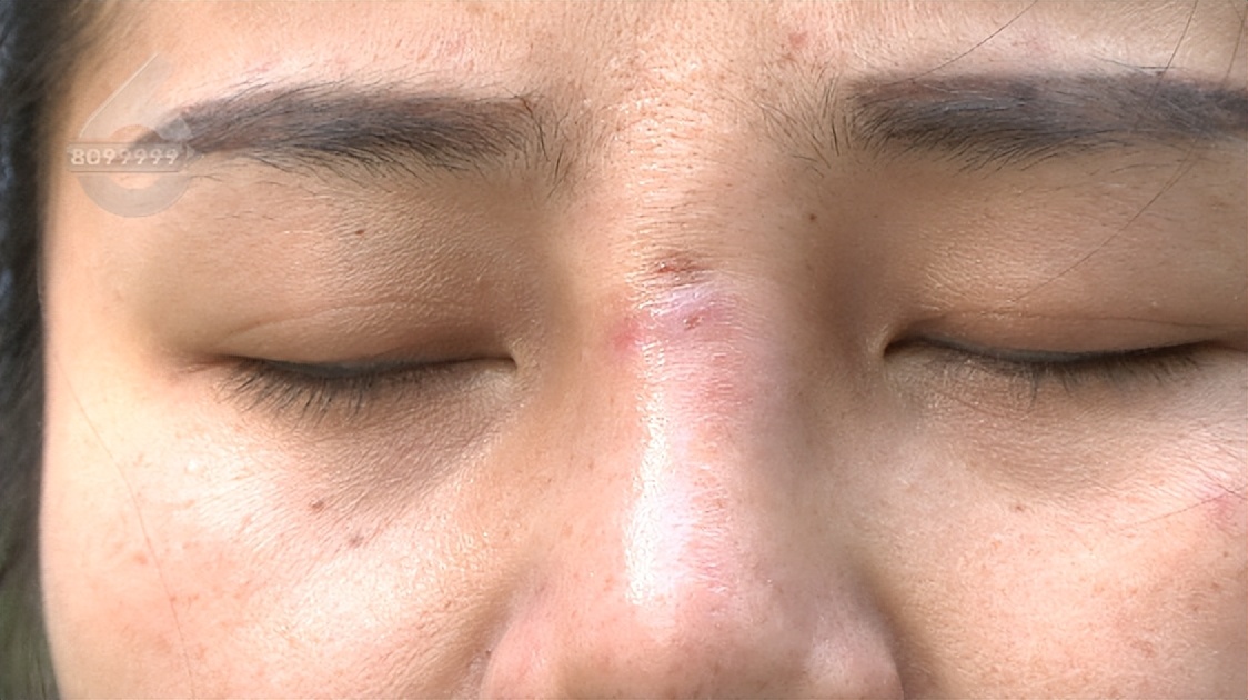 鼻子整形后流脓是不是医疗事故,鼻子整容后流脓怎么处理