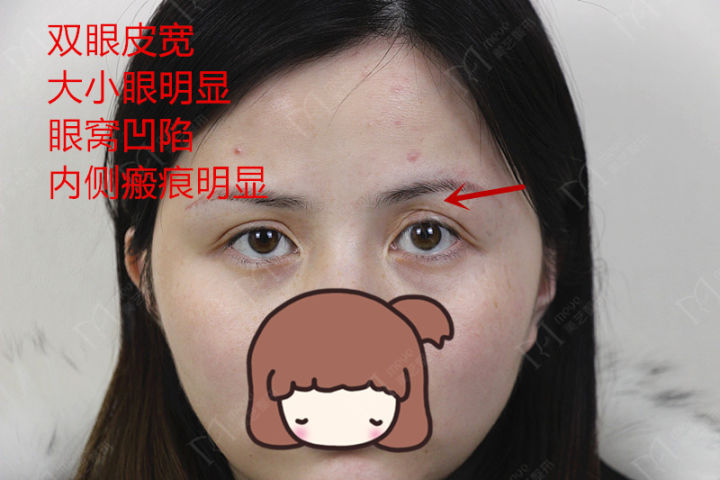 割双眼皮是属于整形还是美容,割双眼皮就是整容吗