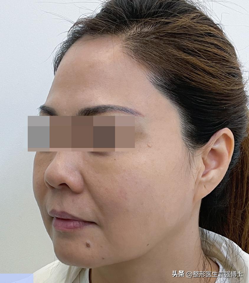 46岁肌肤松弛能做拉皮手术吗,46岁脸部下垂还能做拉皮手术吗