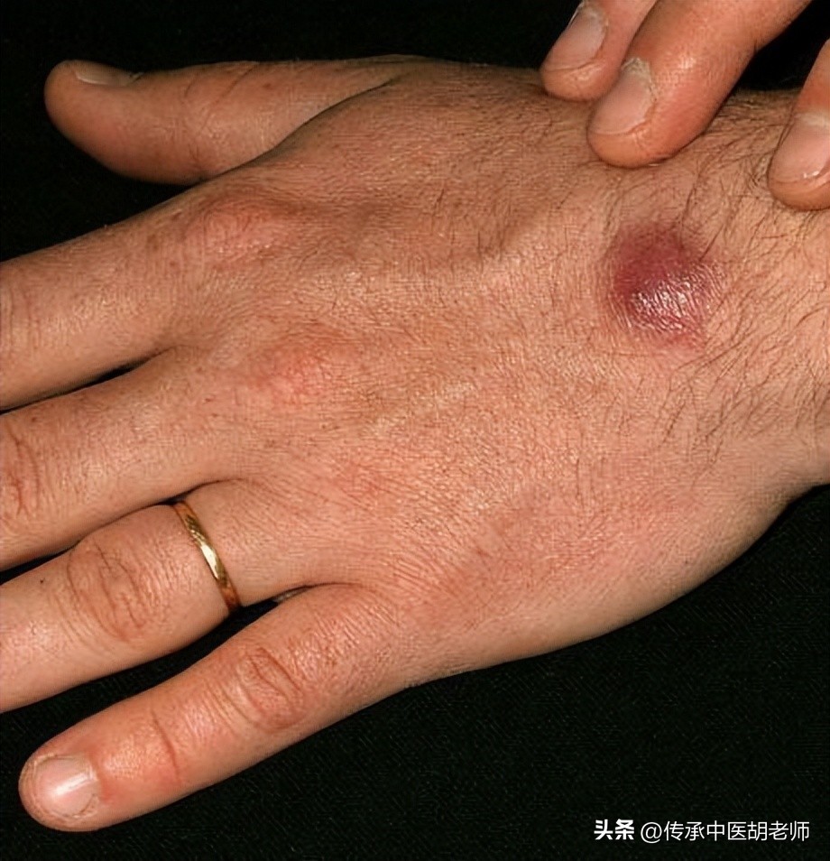 逍遥丸配一物，不仅疏肝解郁，还可治这4种病，建议收藏！