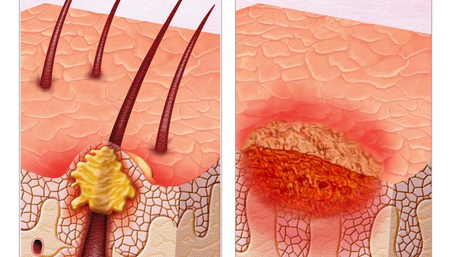 几块钱一瓶的“甲硝唑”，对这几种疾病有很好的治疗效果