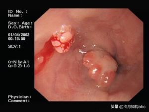 话说息肉：天生我才必有用，身体拒绝“休息之肉”