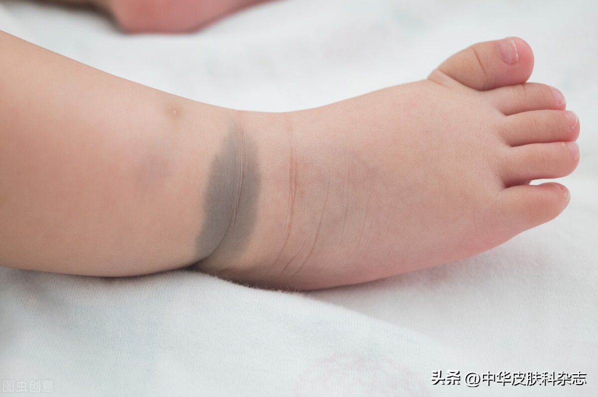 孩子身上有咖啡斑和白斑,儿童身上咖啡色斑