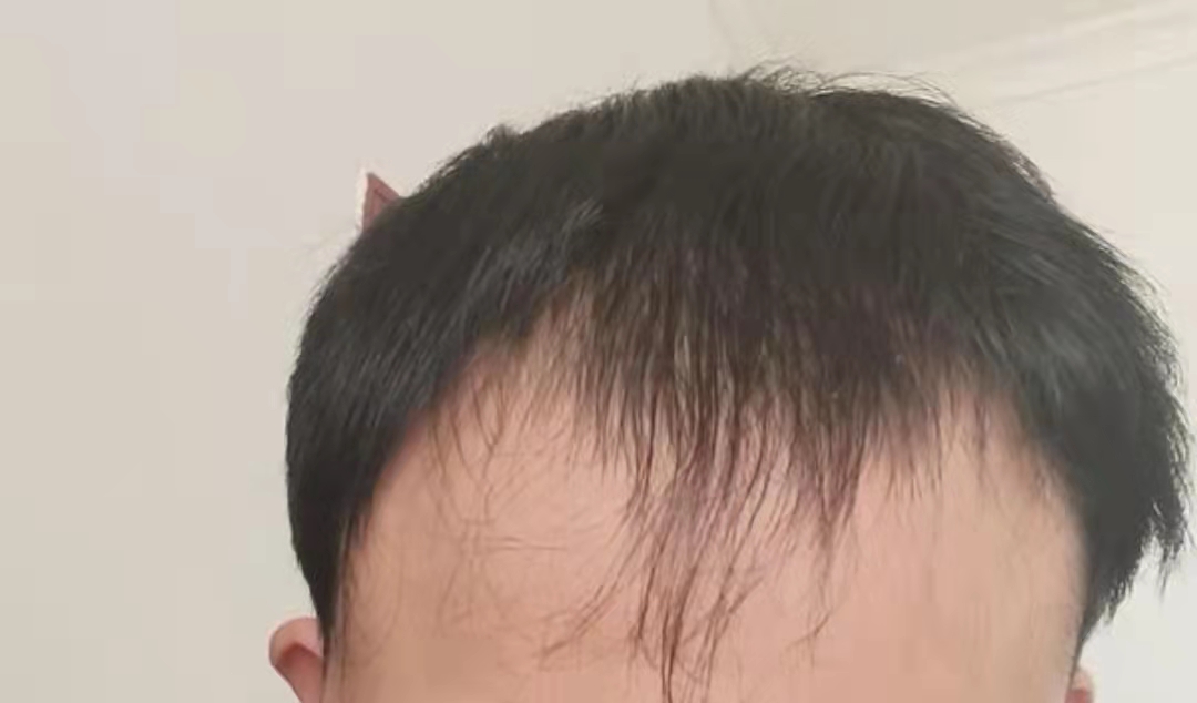 脂溢性脱发治疗第一个月效果,治疗脂溢性脱发最有效的方法