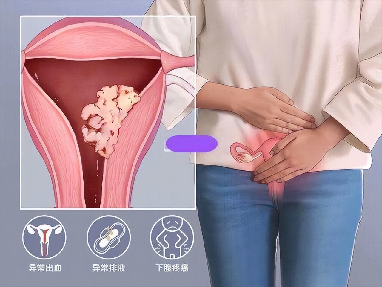 宫颈癌多是拖出来的,得了宫颈癌身体有五个部位有征兆