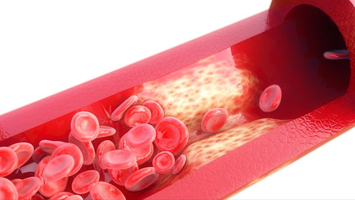 心脏支架手术做了还会堵,还有必要做吗?做与不做取决于这一点