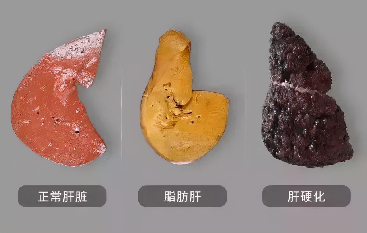 停止食用水洗鸡蛋,吃水煮蛋对肝有影响吗