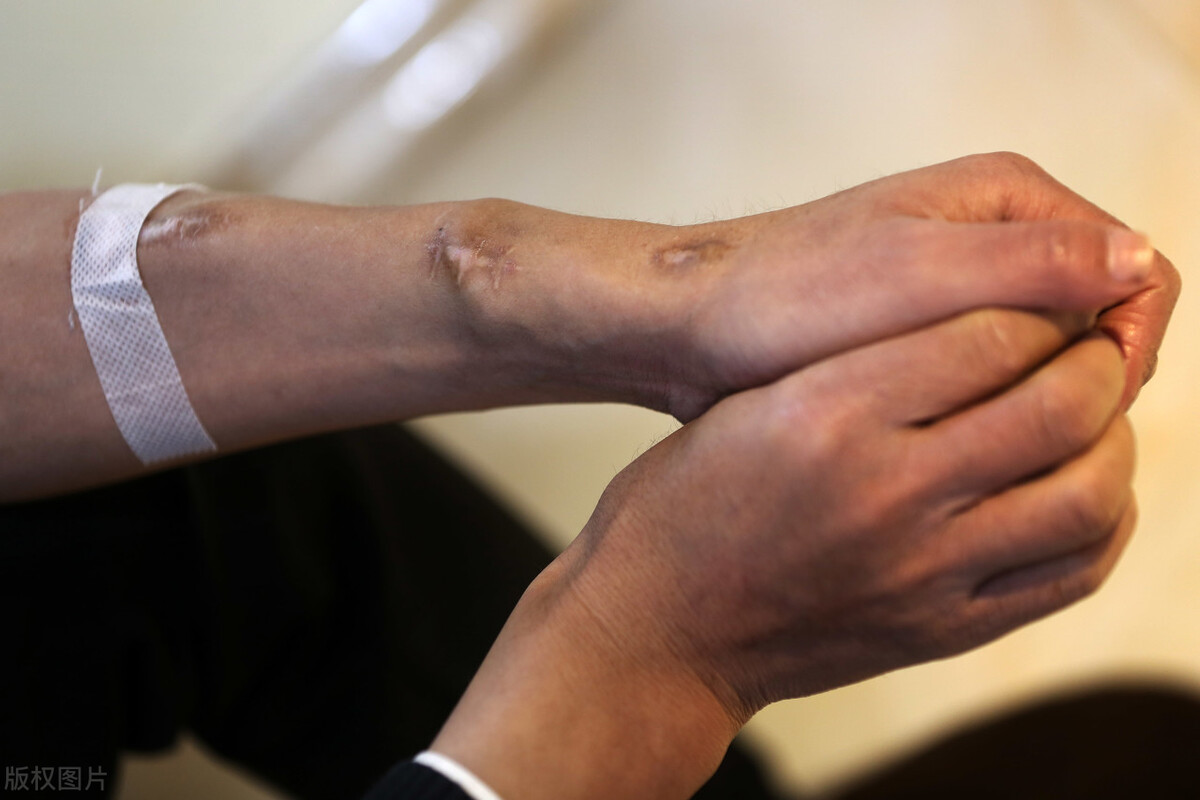 慢性肾炎患者最终都会得尿毒症,如何避免慢性肾炎而诱发的尿毒症