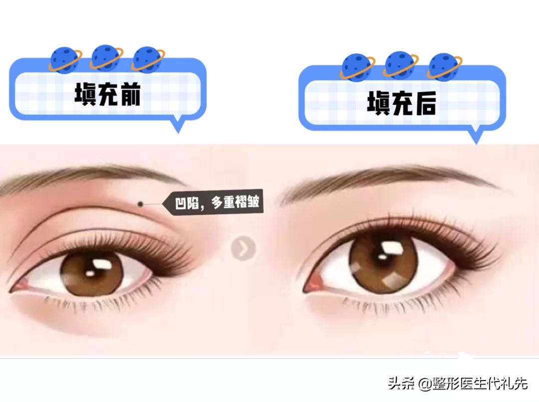 眼窝凹陷眼周脂肪填充眼窝可以吗,眼窝凹陷严重几次眼窝填充好