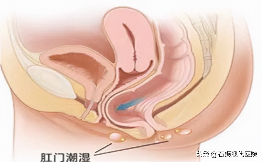 肛周湿疹瘙痒怎么治彻底,肛周湿疹痒得特别厉害怎么办