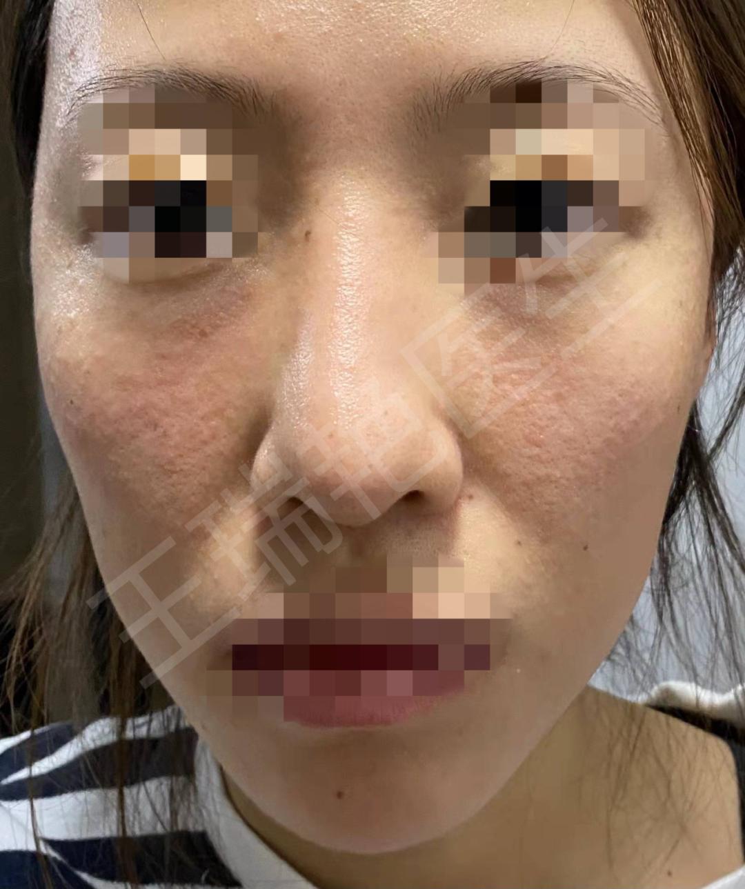 烂脸警告完整视频,烂脸警告