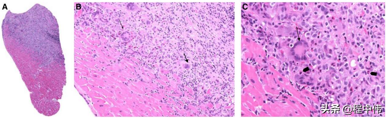暴发性心肌炎及时发现治疗,最新病毒性心肌炎指南