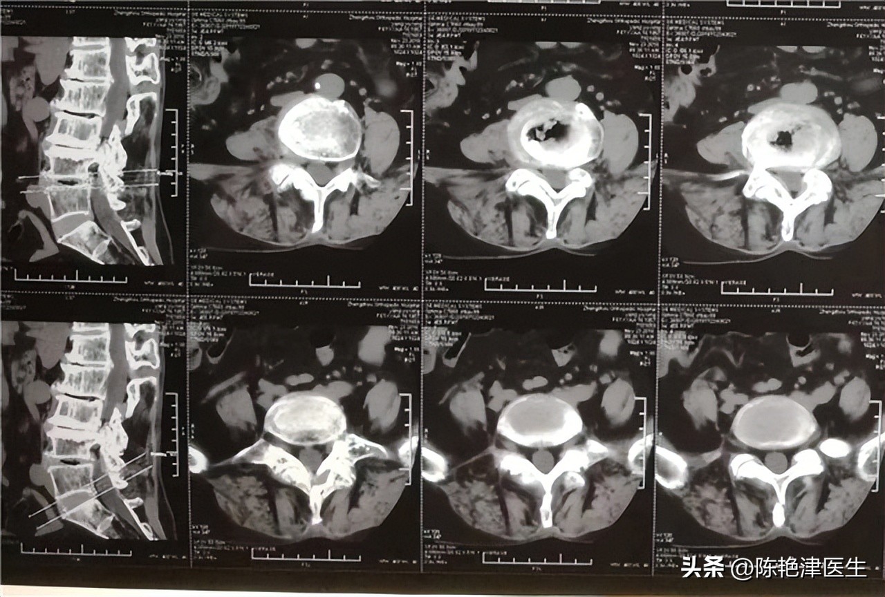 体内有癌腰部先知什么意思,癌引起的腰痛会好转吗