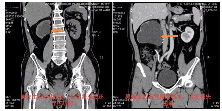 肾积水严重要注意什么,肾积水需要立即治疗吗