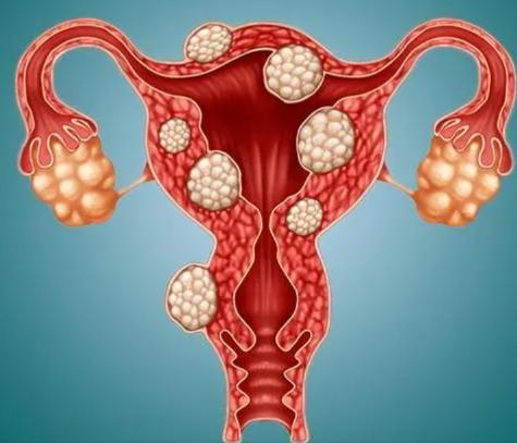 子宫肌瘤千万不要轻易去割掉,为什么子宫肌瘤千万不可割掉