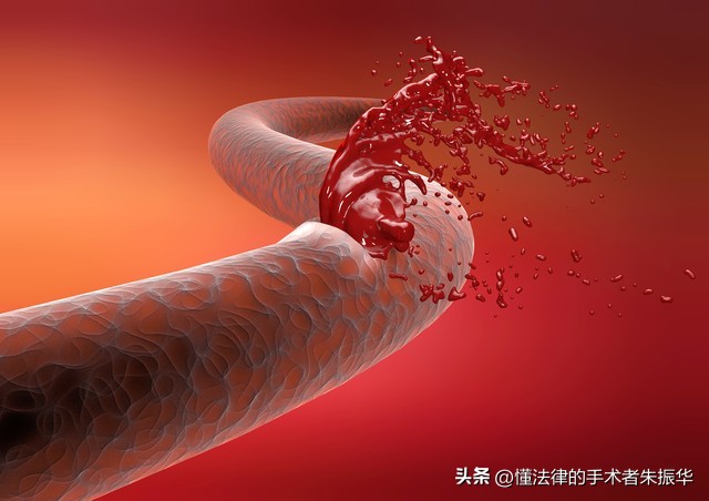 手术后出血一定要谨慎处理