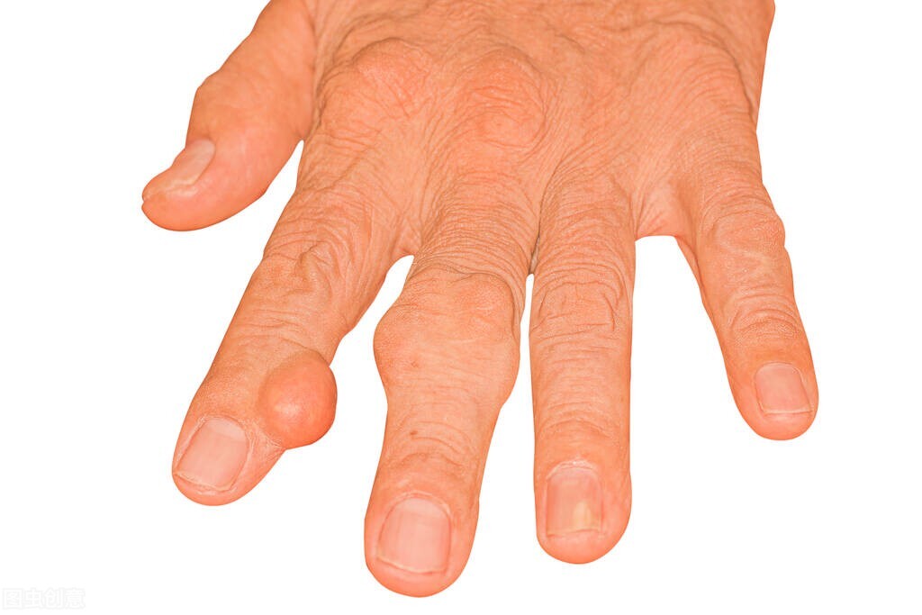 怎么可以把尿酸降下来？生活习惯对尿酸有一定的控制作用