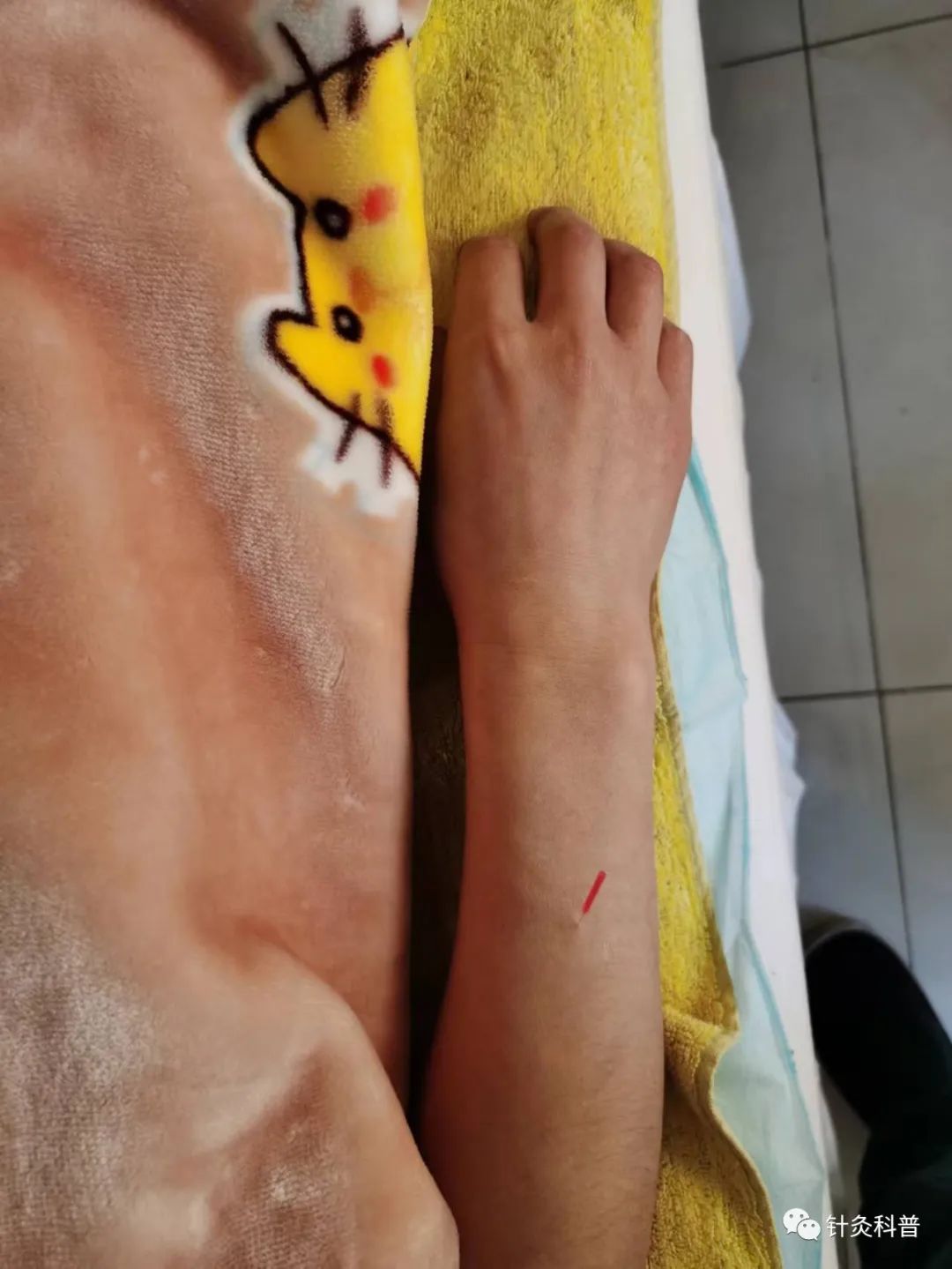 针灸治疗偏头痛的经方,针灸后偏头痛是怎么回事