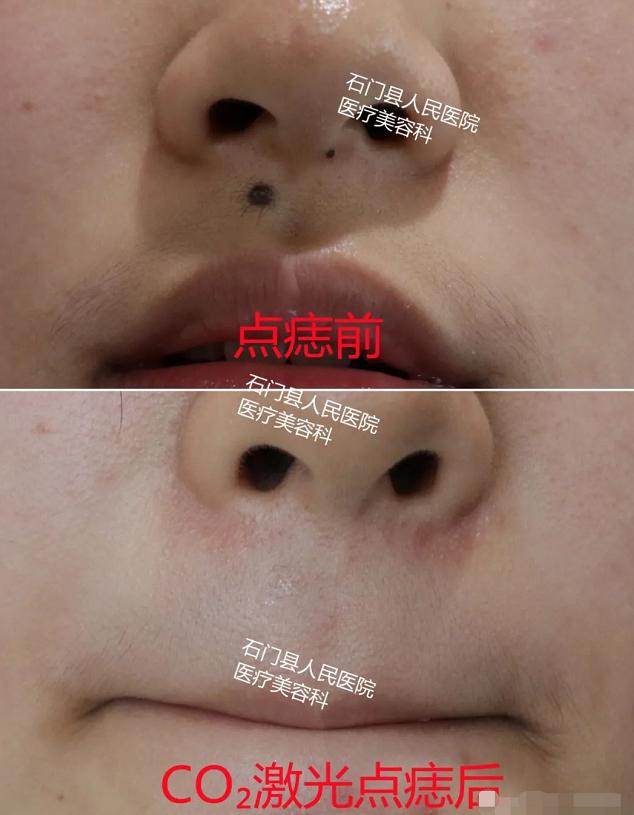 有痣人士点痣要慎重,肉痣怎么点痣最靠谱