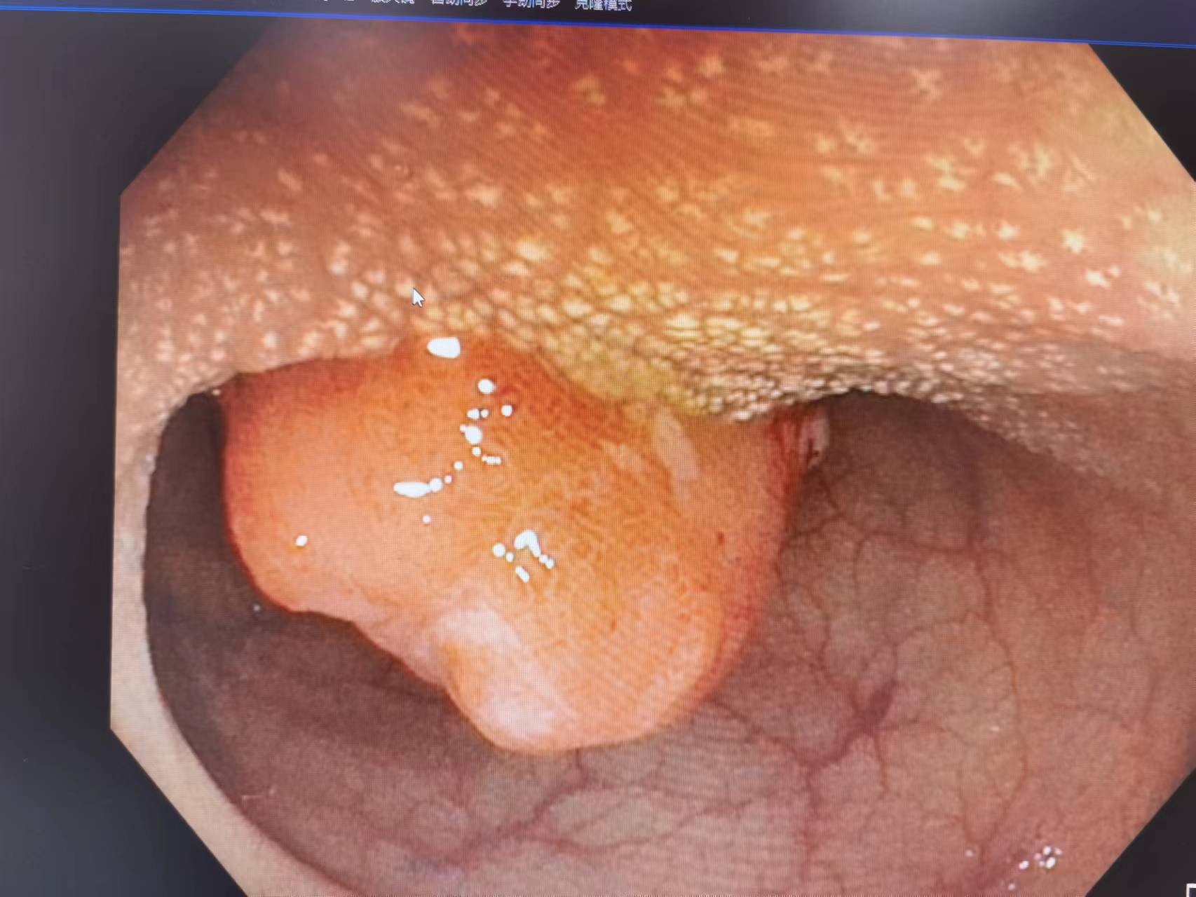 喷射状的便血是痔疮还是肠癌,便血怎么判断是痔疮肛裂还是肠癌