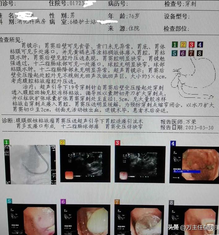 腹腔粘液癌治疗有妙招——万荣教授以内镜Notes技术成功胃减压