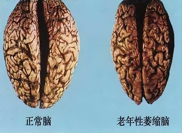 那些让小脑萎缩的神操作,小脑萎缩用什么方法逆转