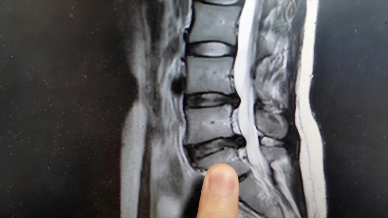 腰椎间盘突出做手术哪种方法更好,腰椎间盘突出医生都会建议做手术