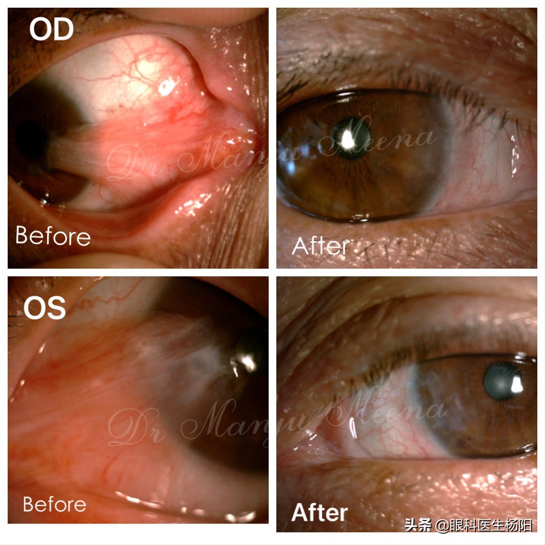 眼球两边有黄肉是什么原因,白眼球上长肉是怎么回事