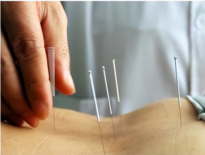 针灸治疗腰痛的方法案例,针灸疗法治疗腰痛主要包括哪些