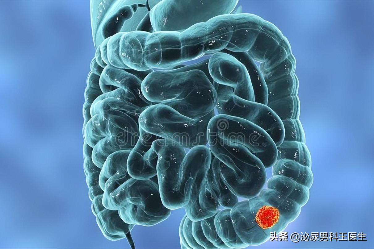直肠癌早期身体发出3个救命信号,直肠癌症状是先下坠还是便血