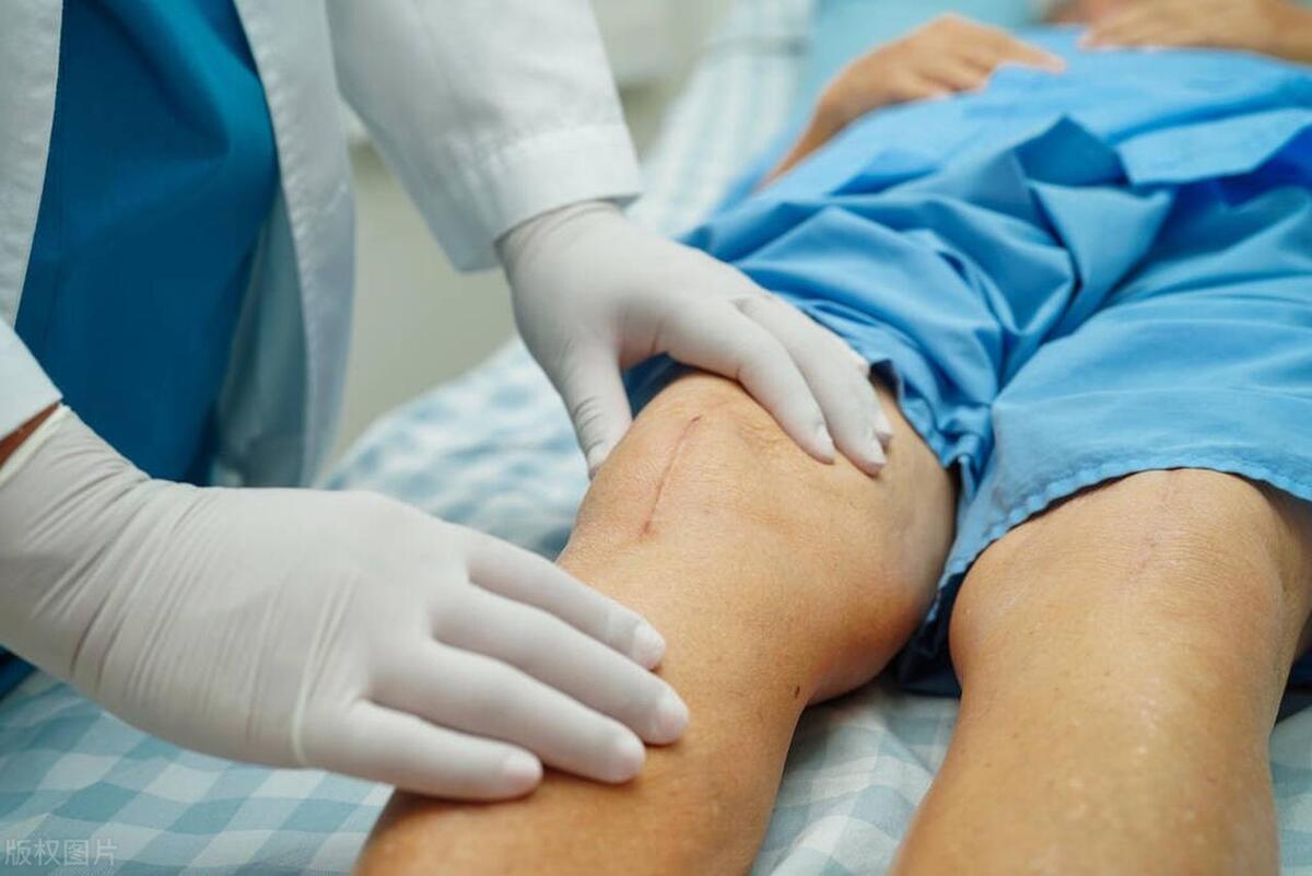 人工膝关节置换术的护理诊断,什么样的情况需要做膝关节置换术
